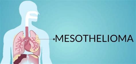 Everything You Need To Know About Mesothelioma Treatment Haaretz