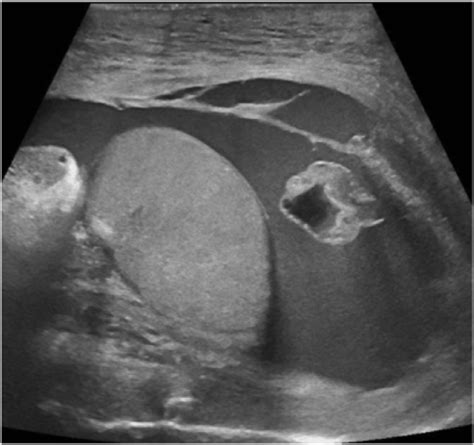 Scrotal Ultrasound Taken A Day After Presentation To The Ed In 2021 Download Scientific