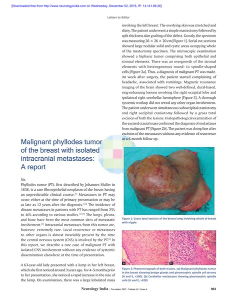 Pdf Malignant Phyllodes Tumor Of The Breast With Isolated