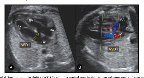 Figure 1 From Three Dimensional Ultrasound In Fetal Atrial Ventricular