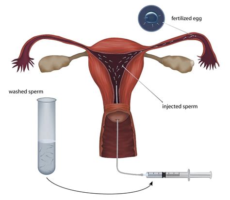 An Illustration Of An Insemination With Iui Ready Sperm