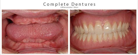 Snap On Dentures - Solution for Loose Lower Dentures