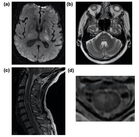 Representative Radiographic Features Of WNV Encephalitis And Acute