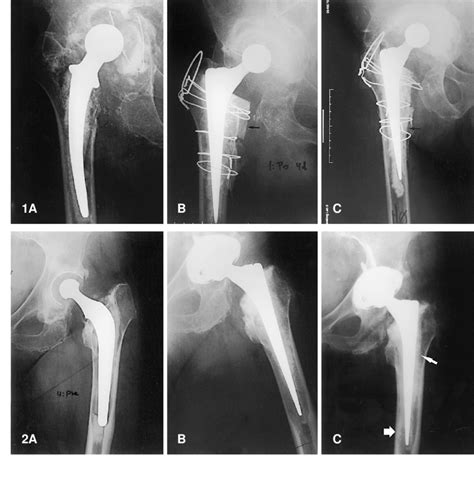 A C Patient No 8 A Pre Revision Radiograph Massive Proximal