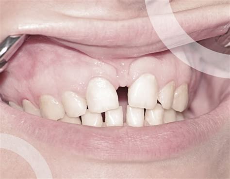 Corriger Des Espaces Entre Les Dents Elone Clinic