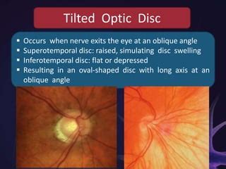 Anatomy of Optic Nerve | PPT