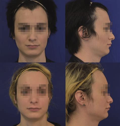 Top Panel Pre Operative Photos Of A Patient Who Underwent Forehead