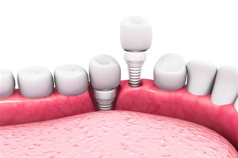 Ceramic Dental Implants Midtown Manhattan Zirconia Metal Free