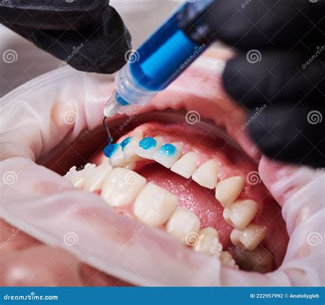 Ceramic Braces Installation Process Stock Photo Image Of Dentist