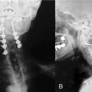 A Anteroposterior And B Lateral Postoperative Radiographs After