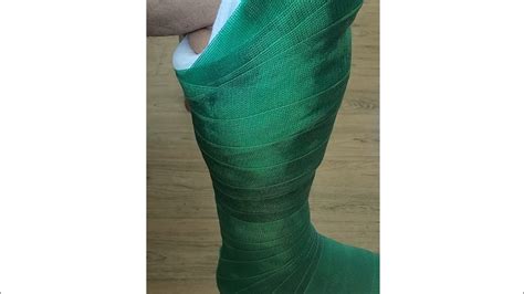 How To Make A Fiberglass PTB Leg Cast Patellar Tendon Bearing Cast