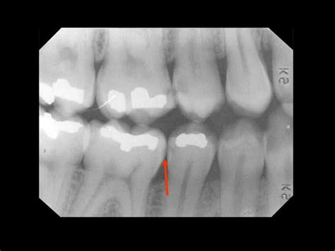 Radiographic Diagnosis Of Dental Caries