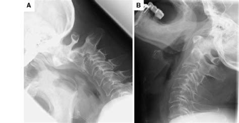 Plain Radiography Of The Cervical Spine Demonstrating Unstable