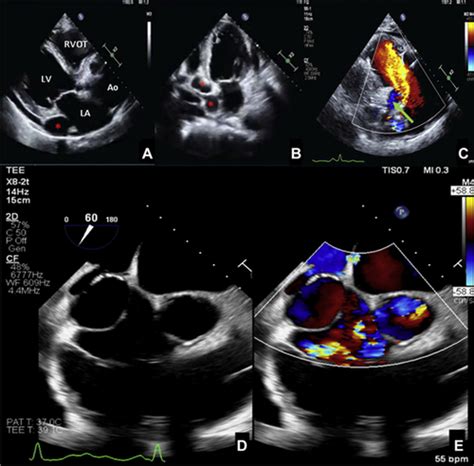 Indispensable Role Of Multimodality Imaging In Diagnosis And Management