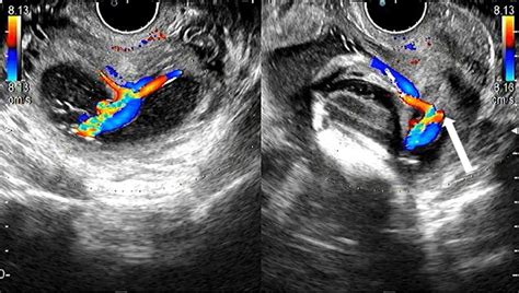 Transvaginal Ultrasonography Image Taken At The First Visit Showing The Download Scientific