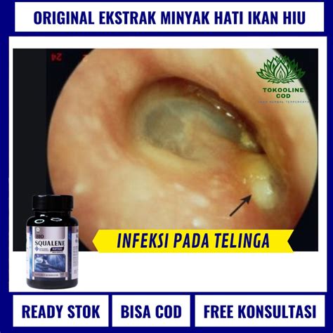 Jual Obat Infeksi Telinga Sakit Telinga Luka Telinga Telinga Bengkak