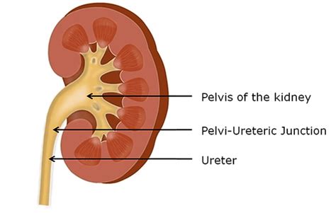 Pelvi-Ureteric Junction (PUJ) Obstruction - Bristol Urology Associates