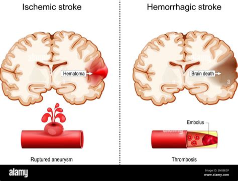 Ictus hemorrágicos e isquémicos Secciones transversales del cerebro