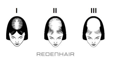 The Ludwig Scale For Female Androgenetic Alopecia Female Pattern Hair