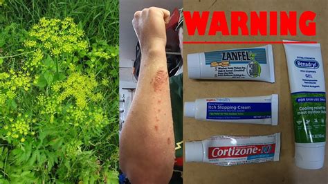 Wild Parsnip Warning Exposure And Treatments Youtube