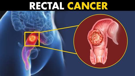 What Happens In Rectal Cancer Symptoms Causes And Treatment Youtube