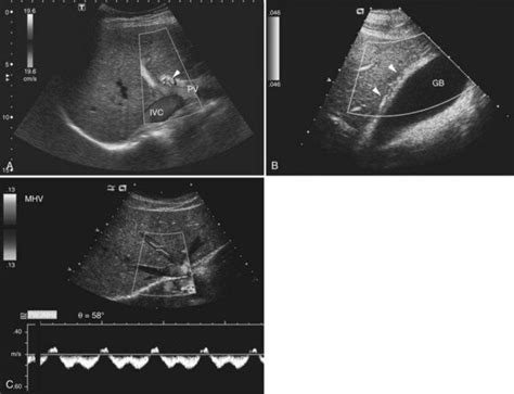 Ultrasound Of The Liver Biliary Tract And Pancreas Clinical Gate