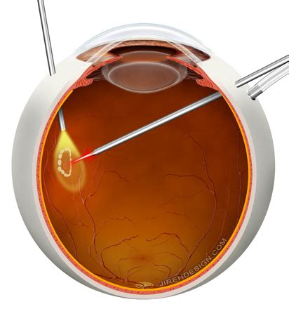 Lattice Degeneration Vitrectomy For Floaters Treatment For Floaters