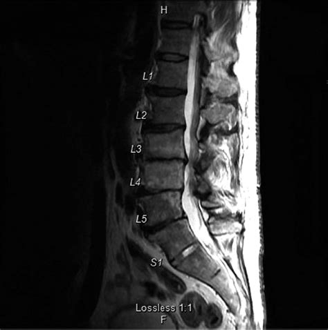 Sagittal Section Of Lumbar Spine Showing Discitis And Osteomyelitis At