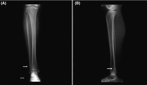 Stress Fracture Fibula X Ray