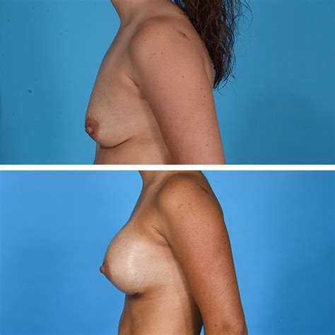 Breast Augmentation Gallery Dr Jeffrey Lisiecki