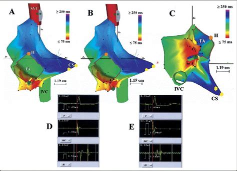 Utility Of Nonfluoroscopic Three Dimensional Electroanatomical Mapping