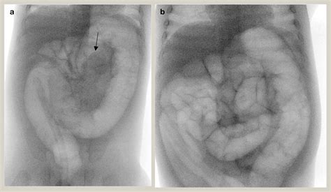 Intussusception Surgery Oxford International Edition