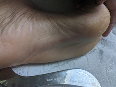 Don't have plantar fasciitis but this Graston I just got hurts SO good