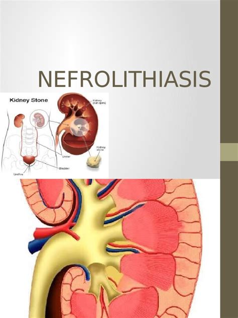 PDF Nefrolitiasis Tutorial DOKUMEN TIPS