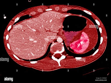 Axial Computed Tomography CT Scan Of The Abdomen Showing A