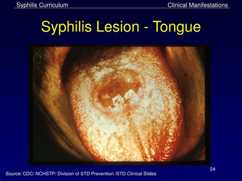 PPT - Syphilis PowerPoint Presentation, free download - ID:1808523