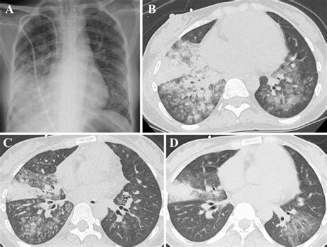 Figure3 Chest Radiography And Chest Ct Images Obtained After The