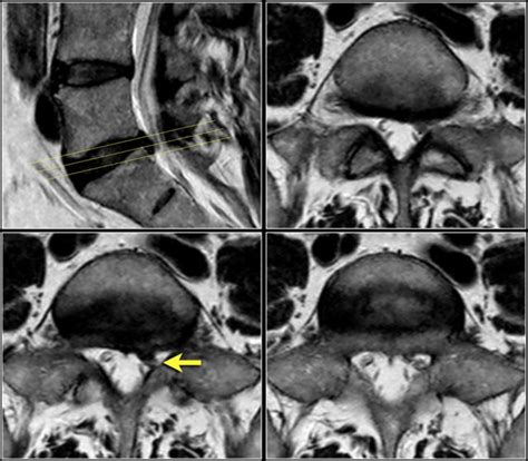 Disc Herniation Mri