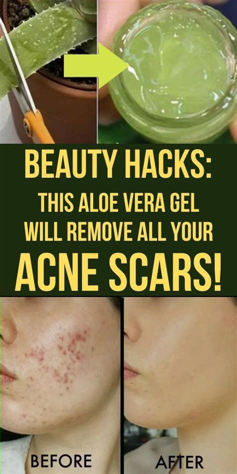 What Happens When You Apply Aloe Vera Daily On Your Face Artofit