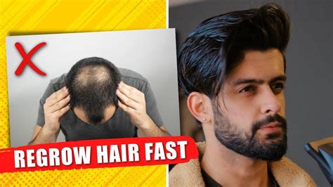 Top 48 image regrow hair for men - Thptnganamst.edu.vn