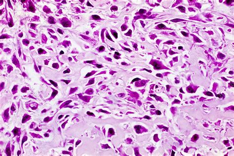 Bone Cancer Light Micrograph Stock Image C Science Photo