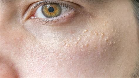 White Spots Under The Eyes - Causes And Effective Treatments