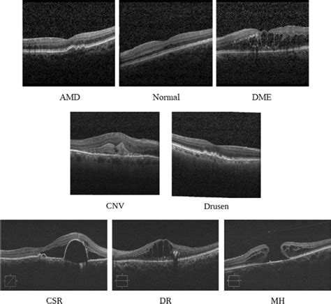 Sample Examples Of OCT Scans Of Different Macular Eye Diseases Top