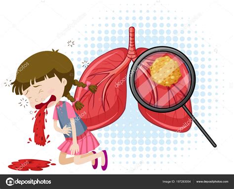 Vector Tuberculosis Illustration Vector Image By Blueringmedia