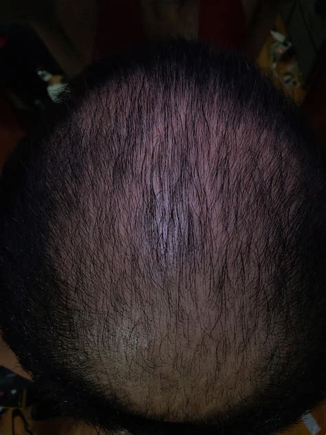 Six Months On Finasteride And Minoxidil Two Weeks Will Update In The Next 6 Months Slow But