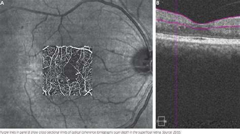 Figure From Angiographic Imaging Of Retinal Vasculature In Specific