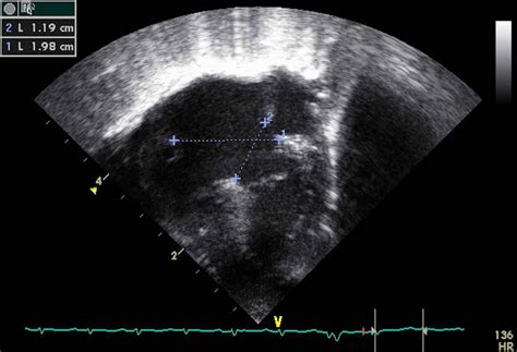 Atrioventricular Septal Defects (AVSD) - TeachMePaediatrics