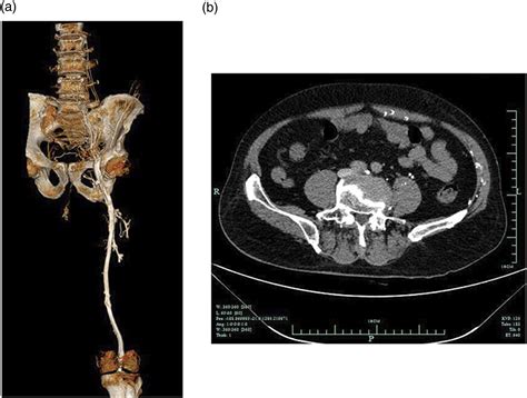 Effect Of The Timing Of Iliac Vein Stent Implantation On Catheter