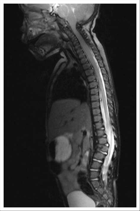 Thecal Sac Mri