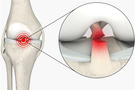 ACL Reconstruction Revision Rockwall TX Manoj Reddy